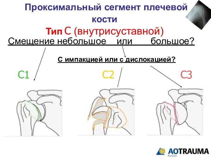 Проксимальный сегмент плечевой кости Тип С (внутрисуставной) С1 С2 С3 Смещение небольшое