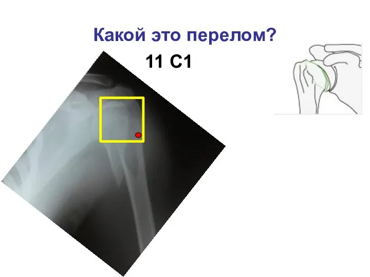 Какой это перелом? 11 С1