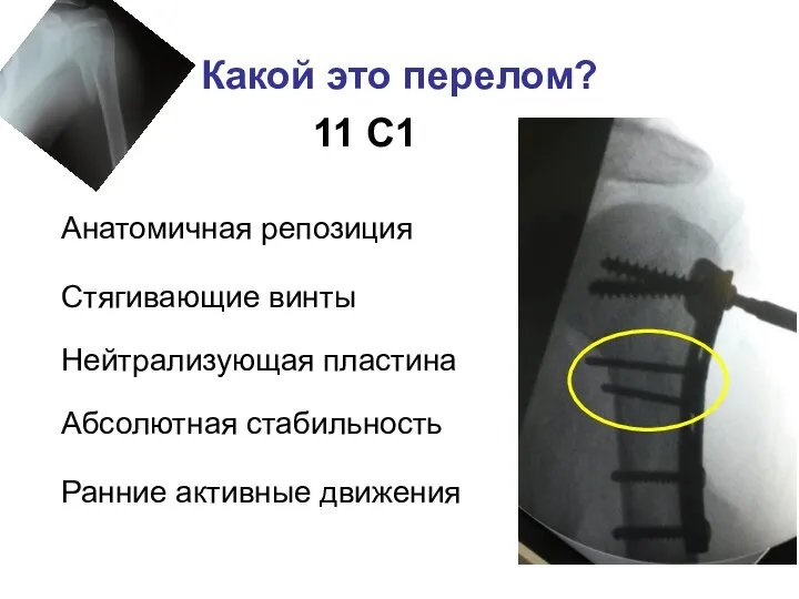 Какой это перелом? 11 С1 Стягивающие винты Анатомичная репозиция Нейтрализующая пластина Абсолютная стабильность Ранние активные движения