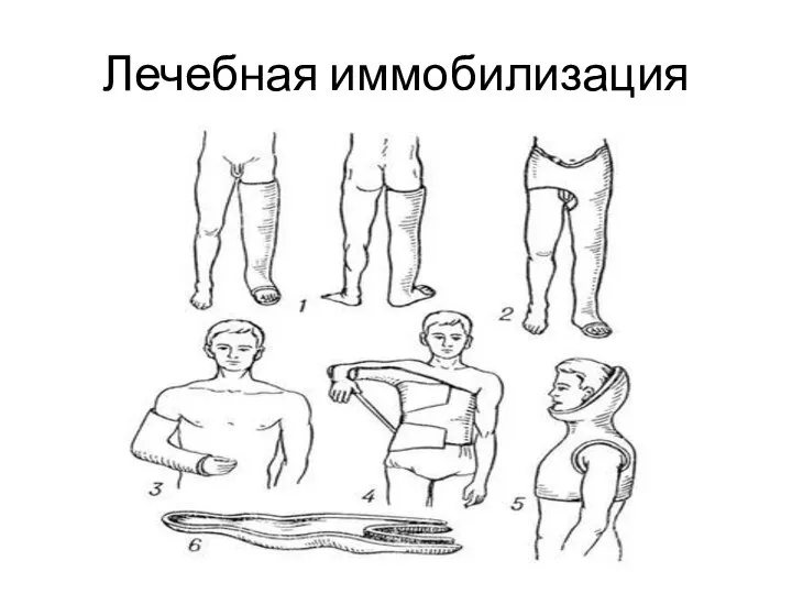 Лечебная иммобилизация