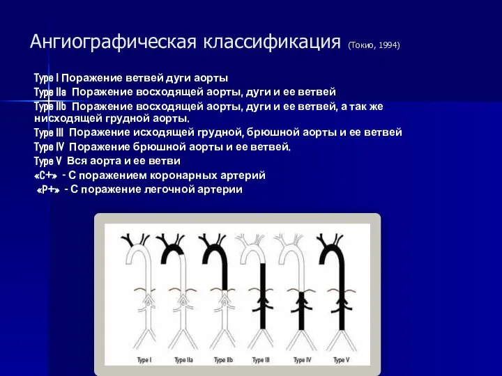 Ангиографическая классификация (Токио, 1994) Type I Поражение ветвей дуги аорты Type IIa