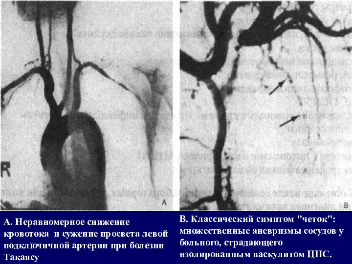 А. Неравномерное снижение кровотока и сужение просвета левой подключичной артерии при болезни