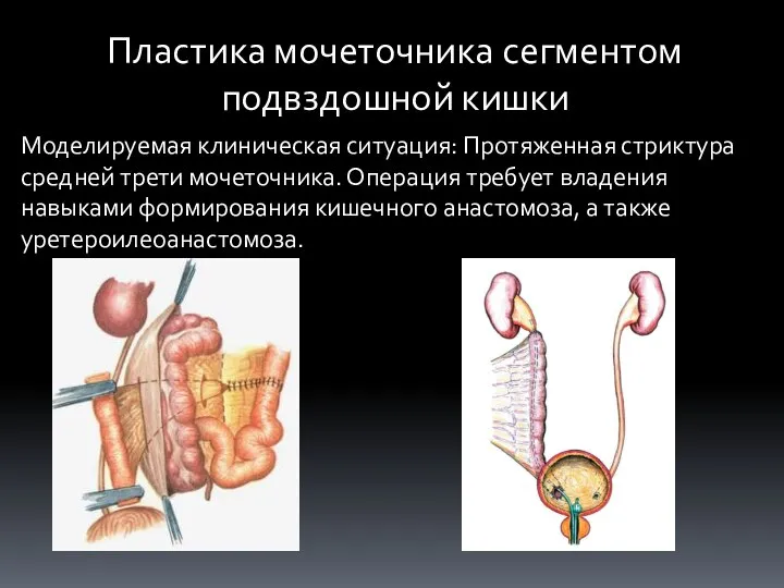 Пластика мочеточника сегментом подвздошной кишки Моделируемая клиническая ситуация: Протяженная стриктура средней трети