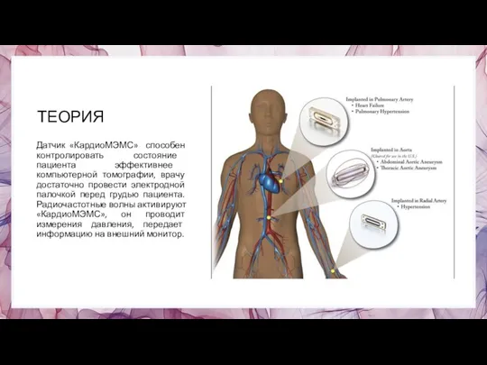 ТЕОРИЯ Датчик «КардиоМЭМС» способен контролировать состояние пациента эффективнее компьютерной томографии, врачу достаточно