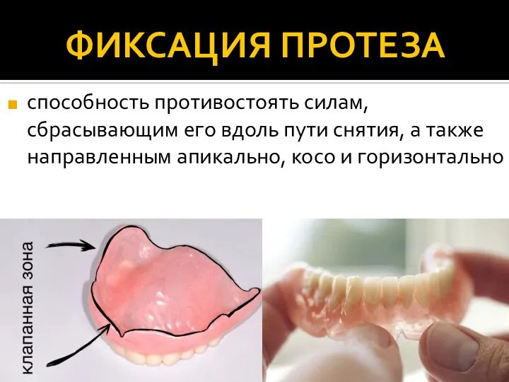 ФИКСАЦИЯ ПРОТЕЗА способность противостоять силам, сбрасывающим его вдоль пути снятия, а также