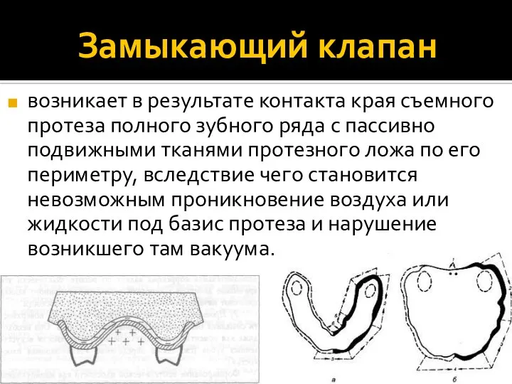 Замыкающий клапан возникает в результате контакта края съемного протеза полного зубного ряда