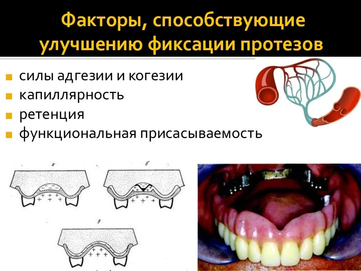 Факторы, способствующие улучшению фиксации протезов силы адгезии и когезии капиллярность ретенция функциональная присасываемость