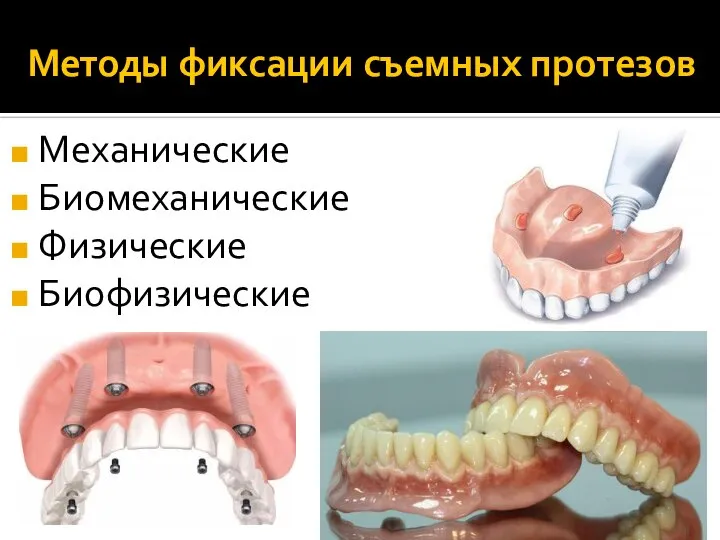 Методы фиксации съемных протезов Механические Биомеханические Физические Биофизические