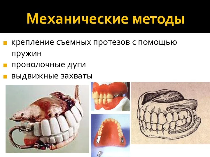 Механические методы крепление съемных протезов с помощью пружин проволочные дуги выдвижные захваты