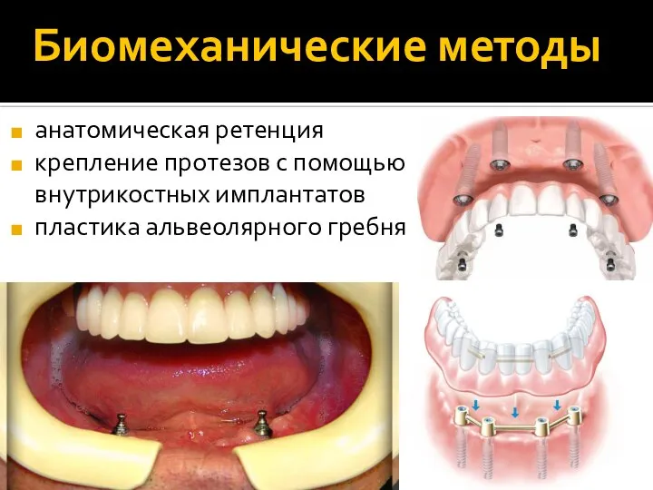 Биомеханические методы анатомическая ретенция крепление протезов с помощью внутрикостных имплантатов пластика альвеолярного гребня