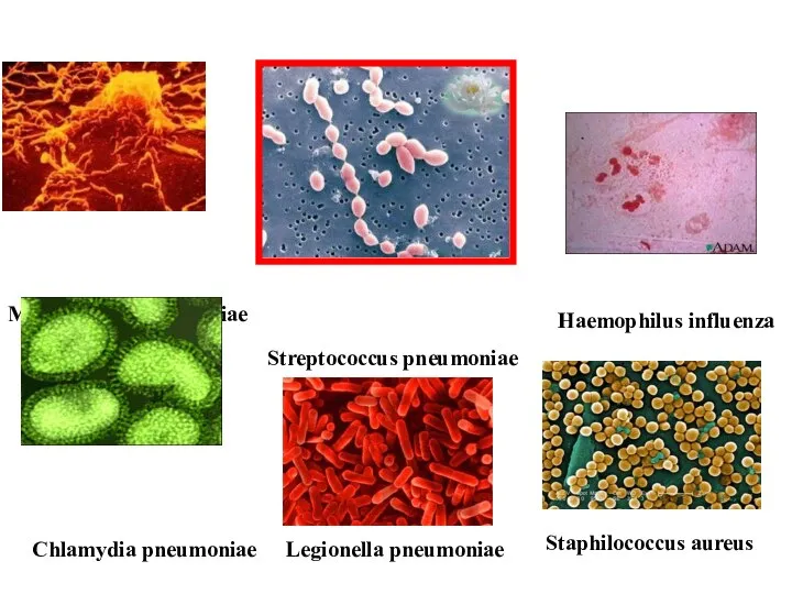 Mycoplasma pneumoniae Streptococcus pneumoniae Haemophilus influenza Chlamydia pneumoniae Legionella pneumoniae Staphilococcus aureus