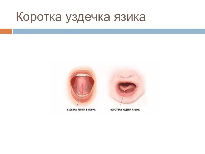 Коротка уздечка язика