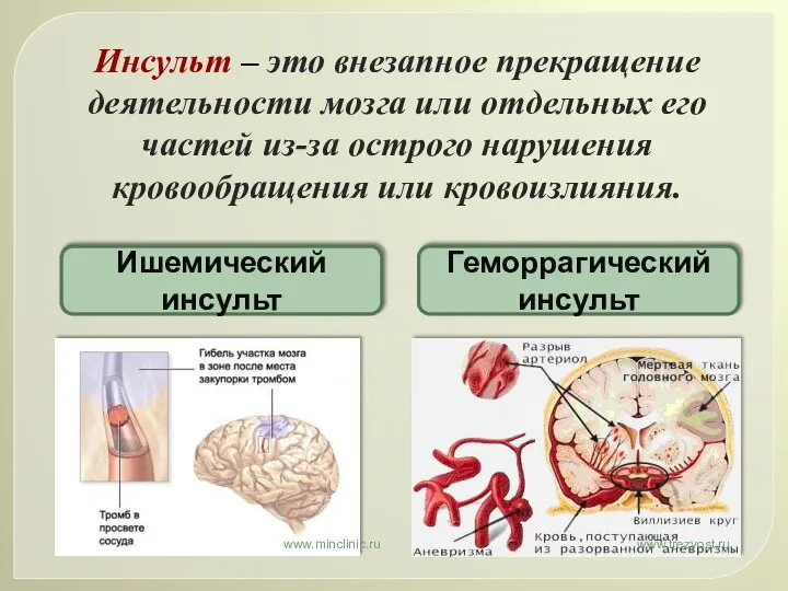 Инсульт – это внезапное прекращение деятельности мозга или отдельных его частей из-за