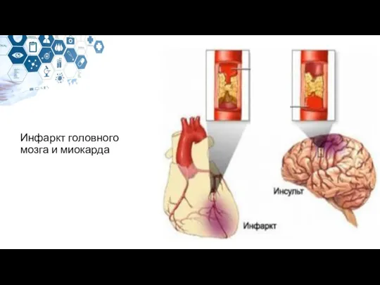 Инфаркт головного мозга и миокарда