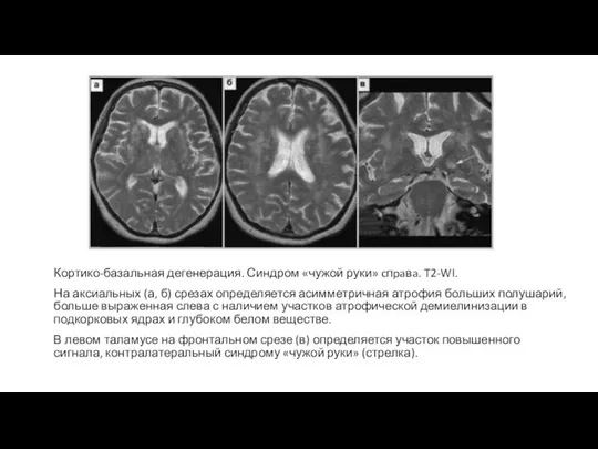 Кортико-базальная дегенерация. Синдром «чужой руки» cпpaвa. T2-WI. На аксиальных (а, б) срезах