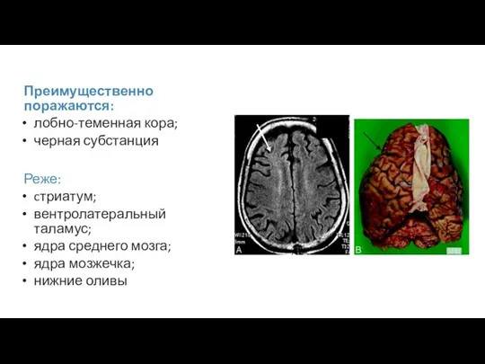 Преимущественно поражаются: лобно-теменная кора; черная субстанция Реже: cтриатум; вентролатеральный таламус; ядра среднего