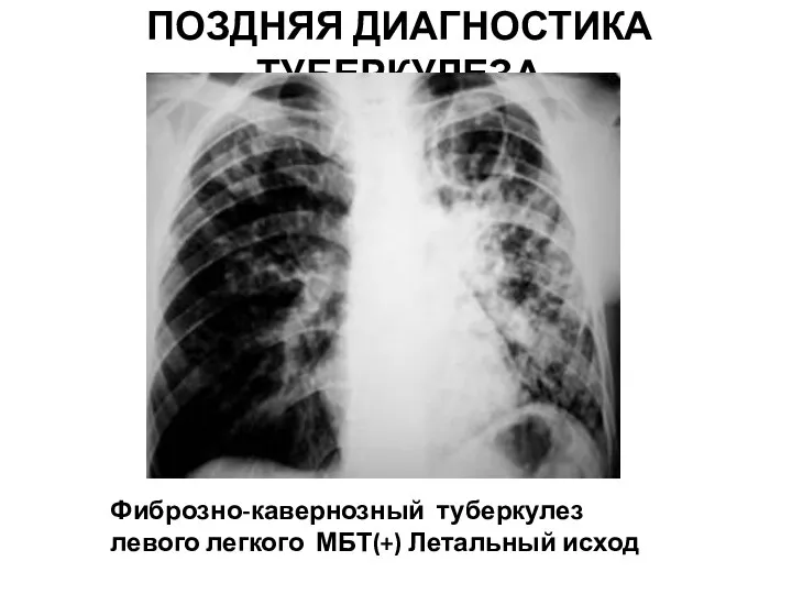 ПОЗДНЯЯ ДИАГНОСТИКА ТУБЕРКУЛЕЗА Фиброзно-кавернозный туберкулез левого легкого МБТ(+) Летальный исход