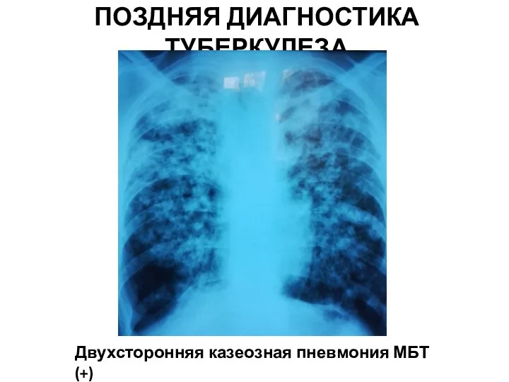 ПОЗДНЯЯ ДИАГНОСТИКА ТУБЕРКУЛЕЗА Двухсторонняя казеозная пневмония МБТ (+)