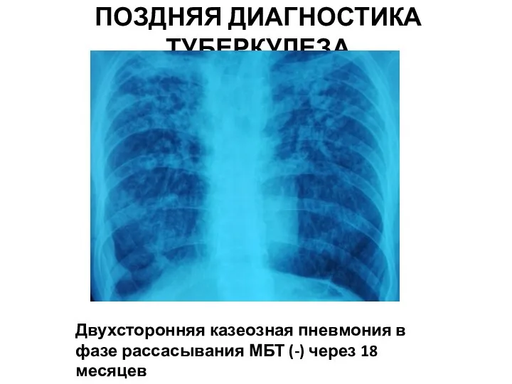 ПОЗДНЯЯ ДИАГНОСТИКА ТУБЕРКУЛЕЗА Двухсторонняя казеозная пневмония в фазе рассасывания МБТ (-) через 18 месяцев