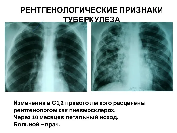 РЕНТГЕНОЛОГИЧЕСКИЕ ПРИЗНАКИ ТУБЕРКУЛЕЗА Изменения в С1,2 правого легкого расценены рентгенологом как пневмосклероз.