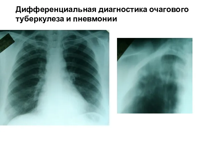 Дифференциальная диагностика очагового туберкулеза и пневмонии