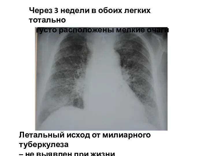 Через 3 недели в обоих легких тотально густо расположены мелкие очаги Летальный