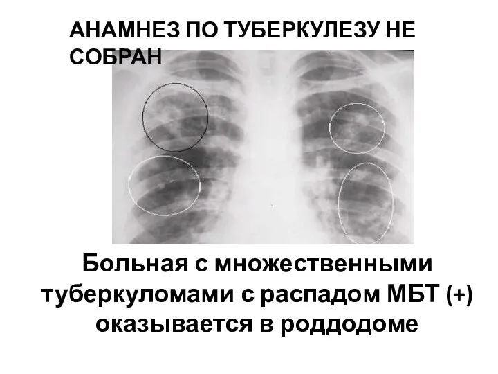 Больная с множественными туберкуломами с распадом МБТ (+) оказывается в роддодоме АНАМНЕЗ ПО ТУБЕРКУЛЕЗУ НЕ СОБРАН