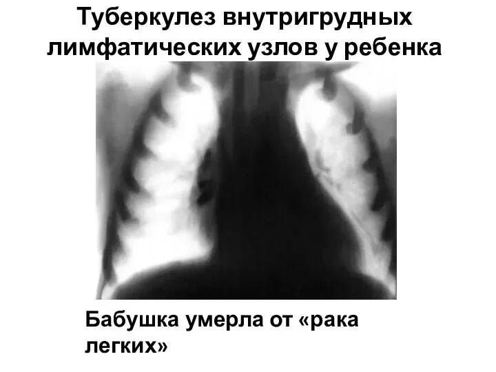 Туберкулез внутригрудных лимфатических узлов у ребенка Бабушка умерла от «рака легких»