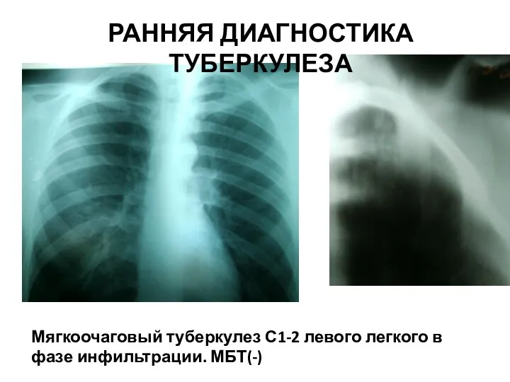 Мягкоочаговый туберкулез С1-2 левого легкого в фазе инфильтрации. МБТ(-) РАННЯЯ ДИАГНОСТИКА ТУБЕРКУЛЕЗА