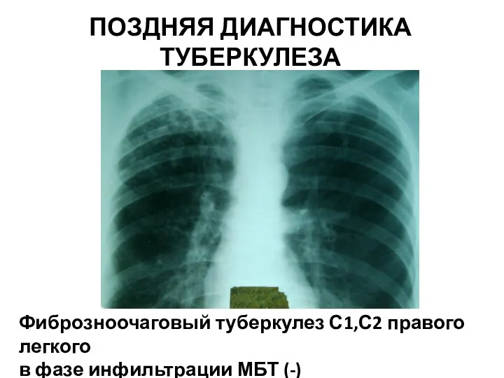 Фиброзноочаговый туберкулез С1,С2 правого легкого в фазе инфильтрации МБТ (-) ПОЗДНЯЯ ДИАГНОСТИКА ТУБЕРКУЛЕЗА