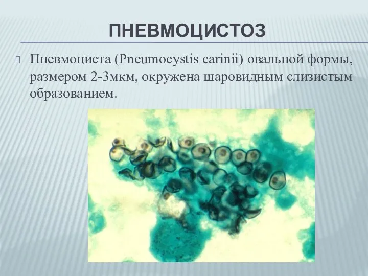 ПНЕВМОЦИСТОЗ Пневмоциста (Pneumocystis carinii) oвальной формы, размером 2-3мкм, окружена шаровидным слизистым образованием.