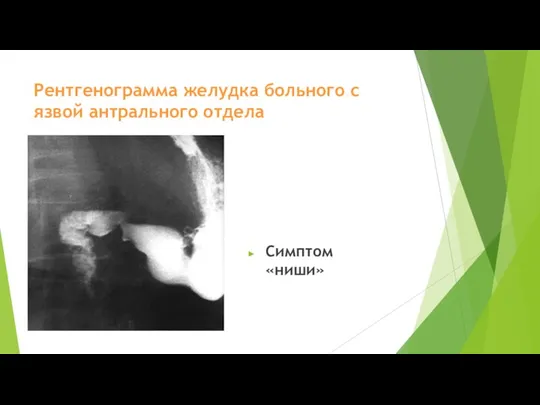 Рентгенограмма желудка больного с язвой антрального отдела Симптом «ниши»