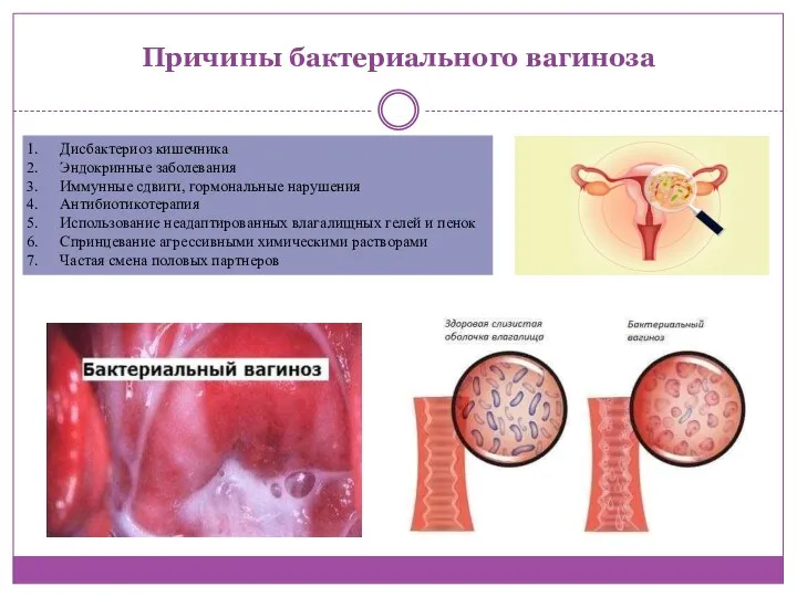 Причины бактериального вагиноза Дисбактериоз кишечника Эндокринные заболевания Иммунные сдвиги, гормональные нарушения Антибиотикотерапия