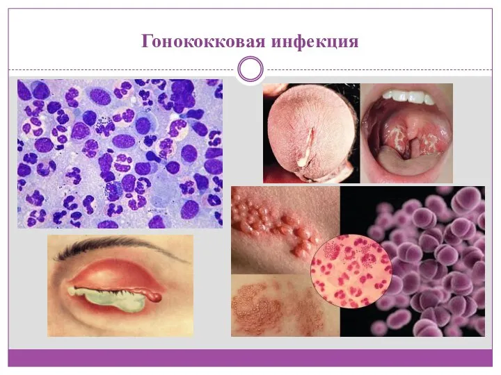 Гонококковая инфекция