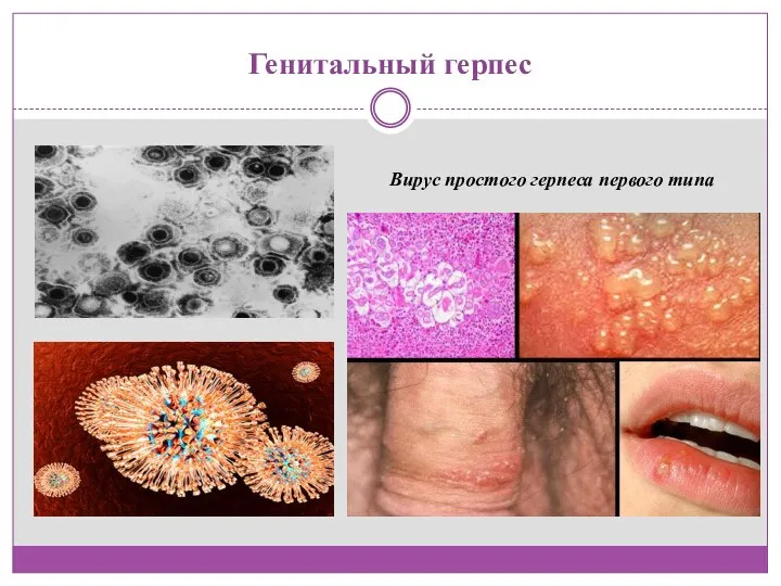 Генитальный герпес Вирус простого герпеса первого типа