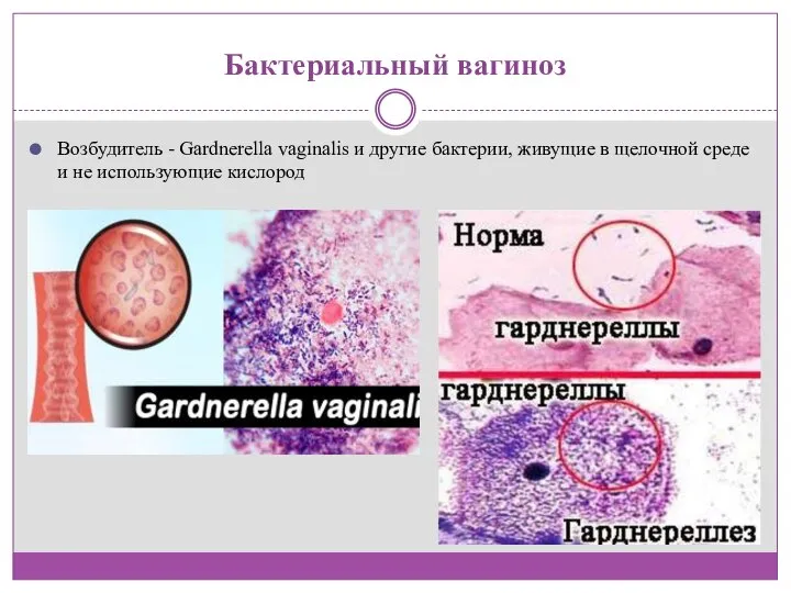 Бактериальный вагиноз Возбудитель - Gardnerella vaginalis и другие бактерии, живущие в щелочной