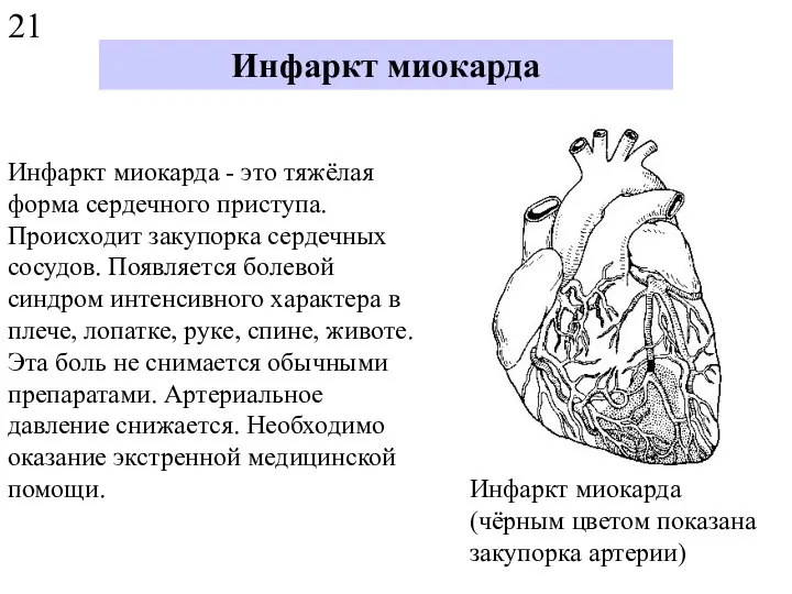 Инфаркт миокарда Инфаркт миокарда - это тяжёлая форма сердечного приступа. Происходит закупорка