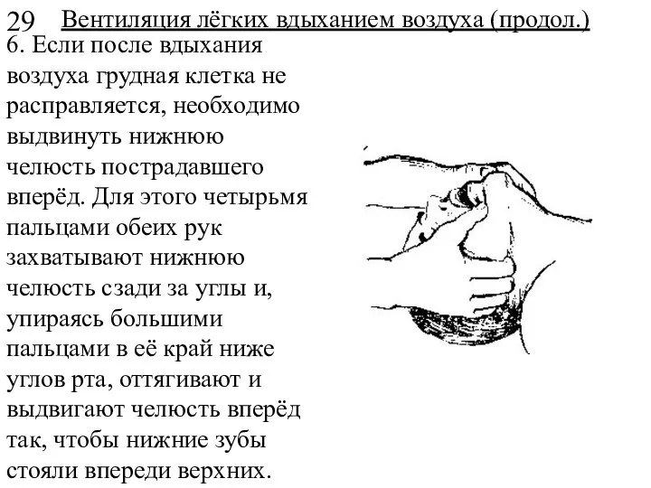 Вентиляция лёгких вдыханием воздуха (продол.) 6. Если после вдыхания воздуха грудная клетка