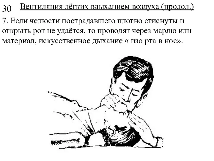 Вентиляция лёгких вдыханием воздуха (продол.) 7. Если челюсти пострадавшего плотно стиснуты и