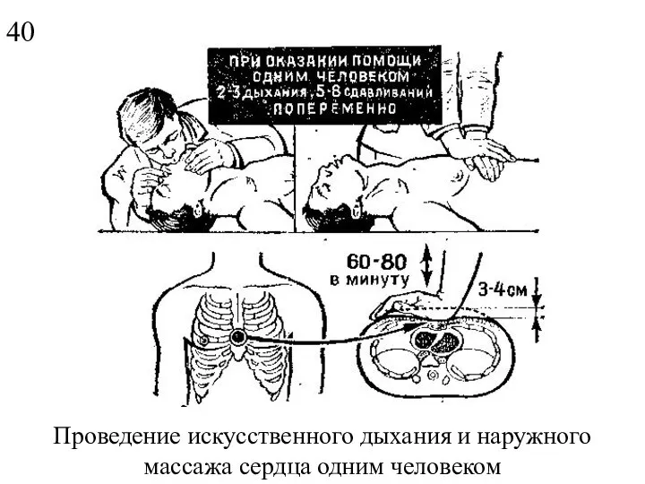 Проведение искусственного дыхания и наружного массажа сердца одним человеком 40