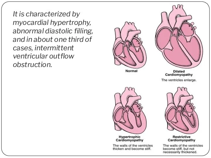 It is characterized by myocardial hypertrophy, abnormal diastolic filling, and in about