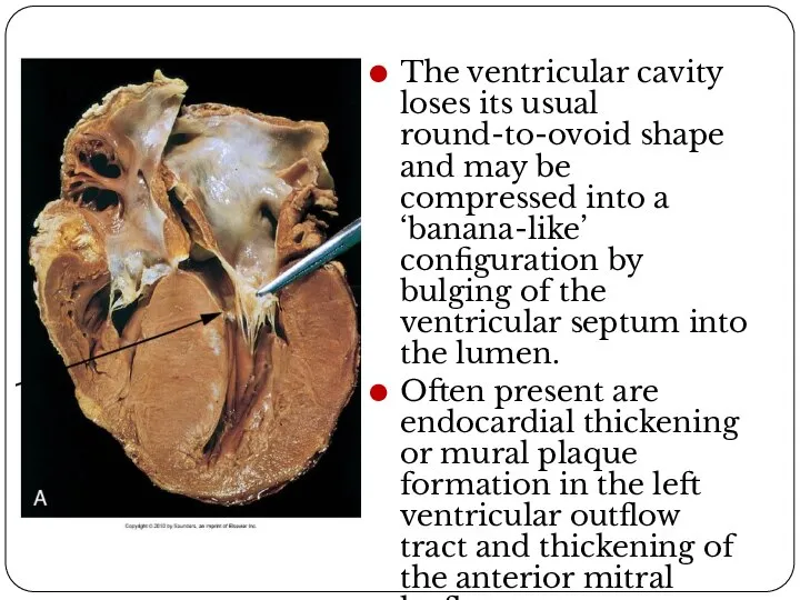 Macro image The ventricular cavity loses its usual round-to-ovoid shape and may