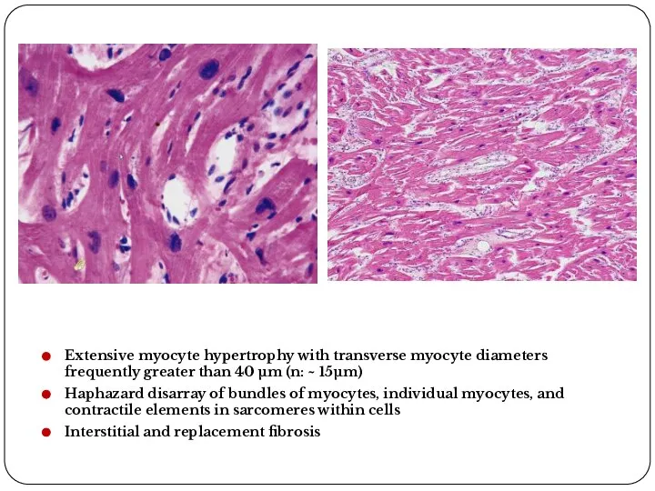 Extensive myocyte hypertrophy with transverse myocyte diameters frequently greater than 40 μm