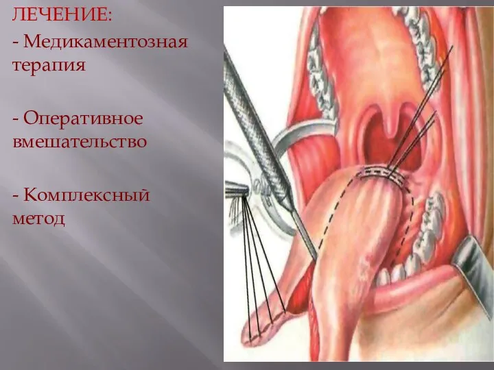 ЛЕЧЕНИЕ: - Медикаментозная терапия - Оперативное вмешательство - Комплексный метод