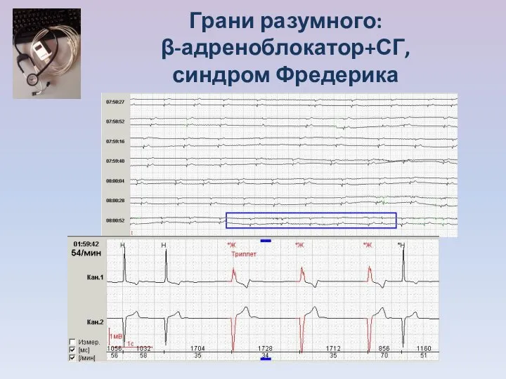 Грани разумного: β-адреноблокатор+СГ, синдром Фредерика