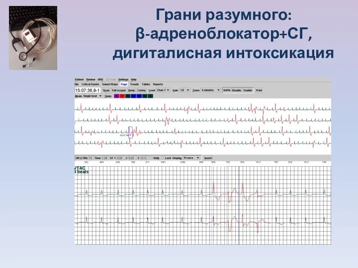 Грани разумного: β-адреноблокатор+СГ, дигиталисная интоксикация