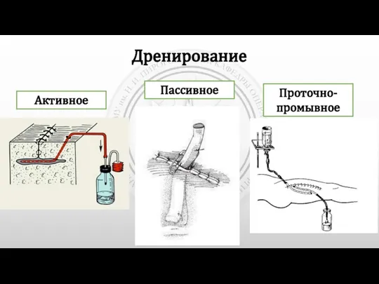 Дренирование Активное Пассивное Проточно-промывное