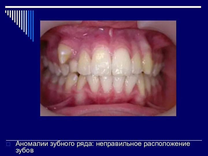 Аномалии зубного ряда: неправильное расположение зубов