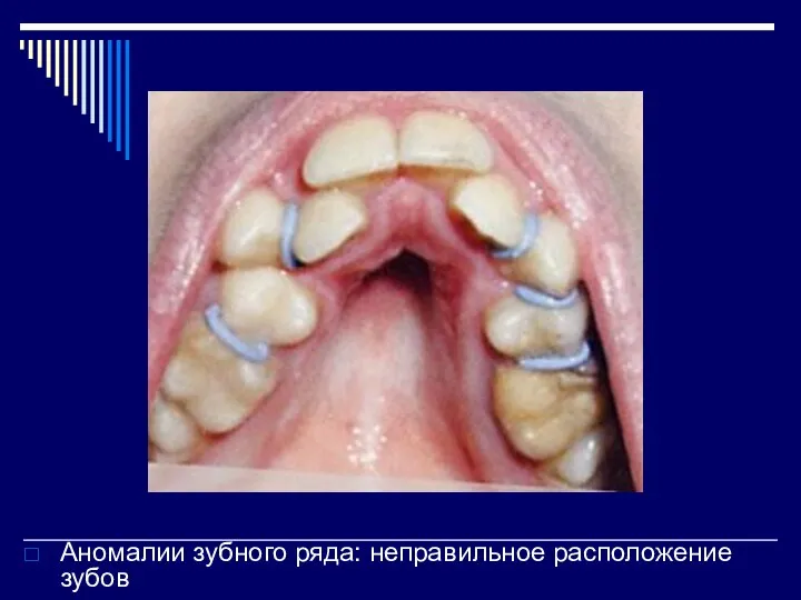 Аномалии зубного ряда: неправильное расположение зубов