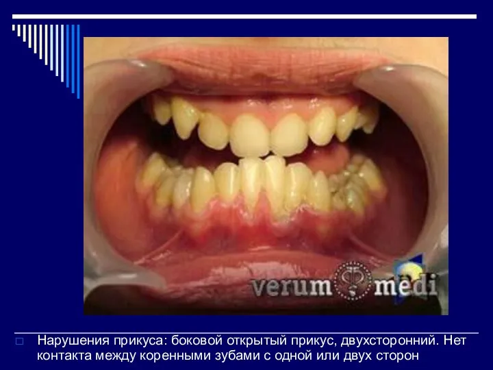 Нарушения прикуса: боковой открытый прикус, двухсторонний. Нет контакта между коренными зубами с одной или двух сторон